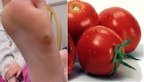 مدیریت میخچه پا با رب گوجه فرنگی- لیمونا